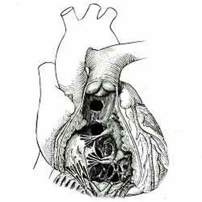 Дефект межжелудочковой перегородки