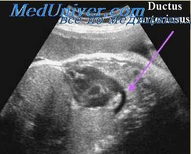 дефект перегородки сердца