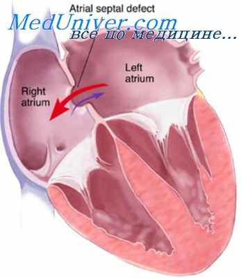дефект межжелудочковой перегородки