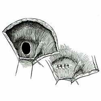 Ушивание дефекта межжелудочковой перегородки