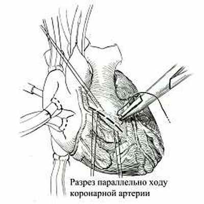Оперативный доступ при дефекте межжелудочковой перегородки