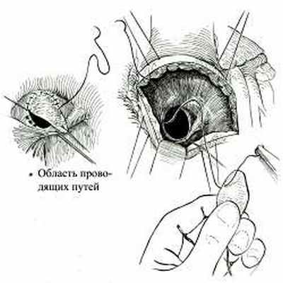 Пластика дефекта межжелудочковой перегородки