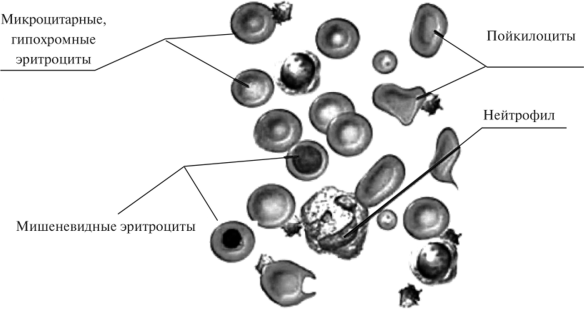 Картина периферической крови при талассемии (по Lippincott Williams-Wilkins, 2010)