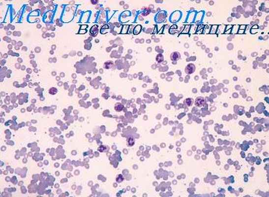 гемоглобинозы