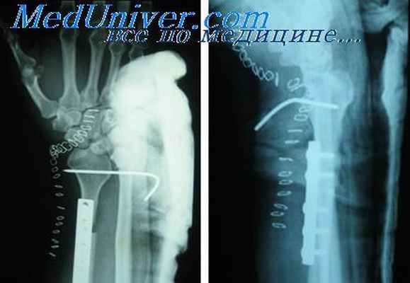 деформация кисти