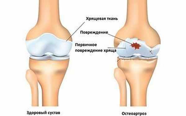 Остеофиты при артрозе кистей рук