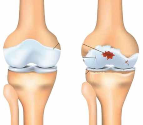 Сравнение здорового и истощенного артритом хряща