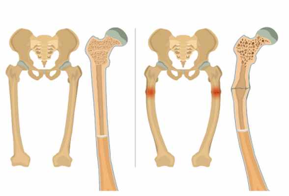 Здоровые и пораженные остеомаляцией костные ткани