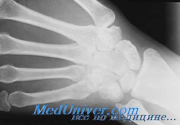 деструкция кости