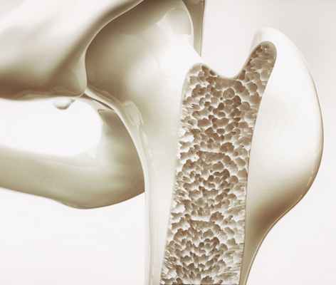 Пористая кость в разрезе при остеопорозе