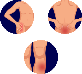 Боли в костях ног, таза, спины при остеомаляции