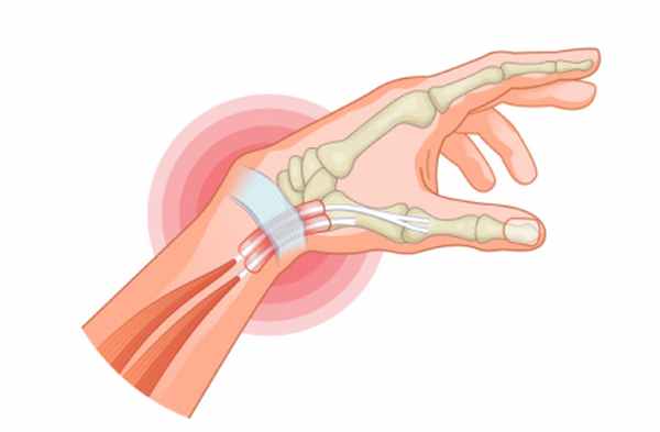 Воспалительный процесс в сухожилиях при тендините