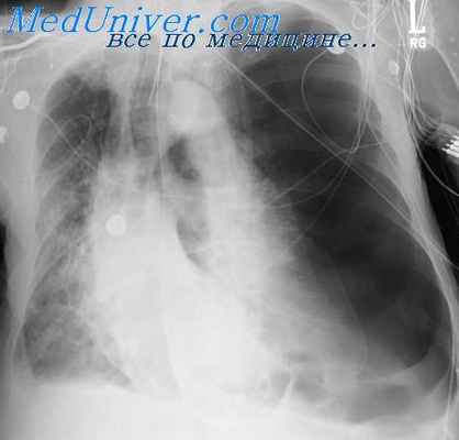 декомпрессионные нарушения