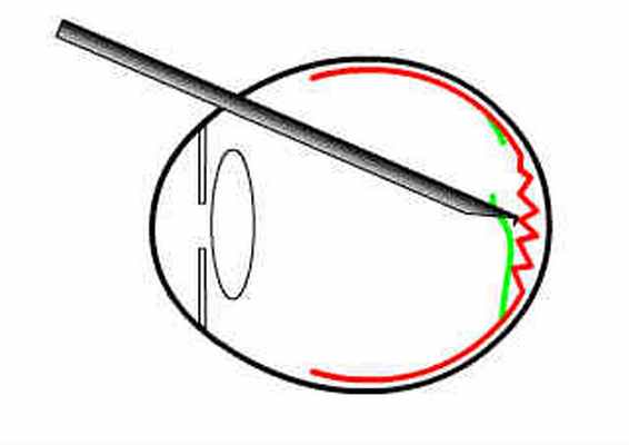 Лечение эпиретинальной мембраны глаза в Москве