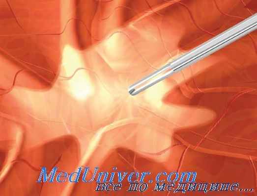 эпиретинальная мембрана