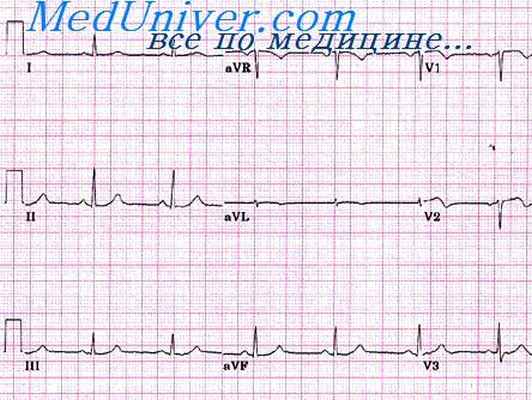 деполяризация миокарда