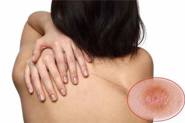 Дерматофиброма кожи