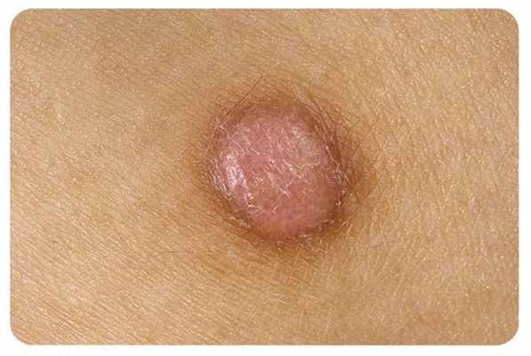 причины появления дерматофибромы