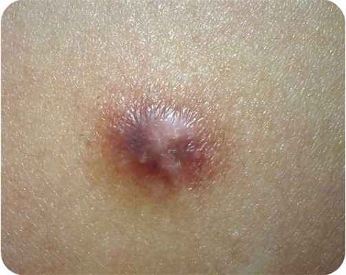 дерматофиброма кожи