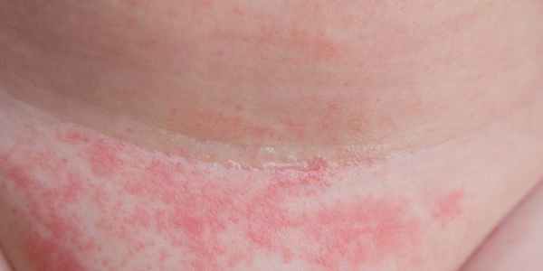 Дерматомикоз: кожный кандидоз