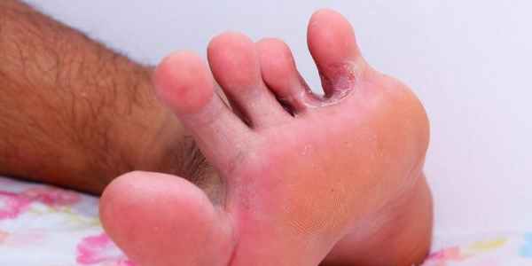 Грибок стопы: нога спортсмена