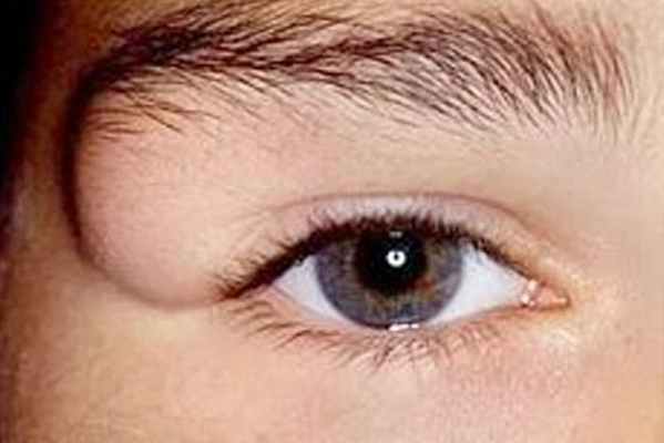 Дермоидная киста фото