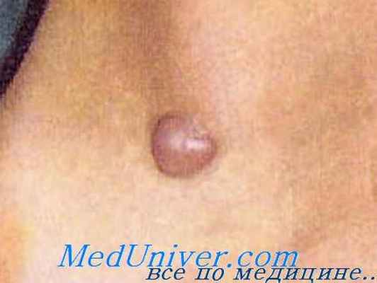 триходискома