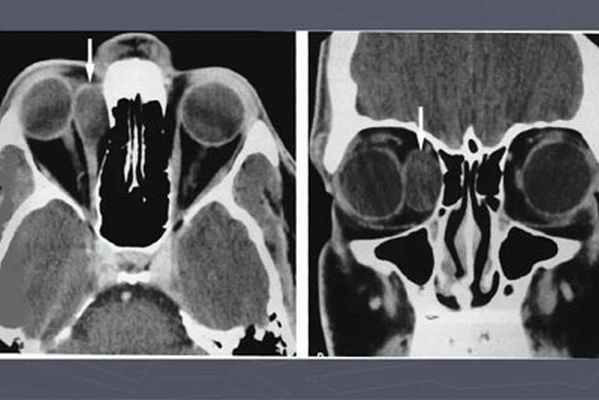 Киста на снимке картинка
