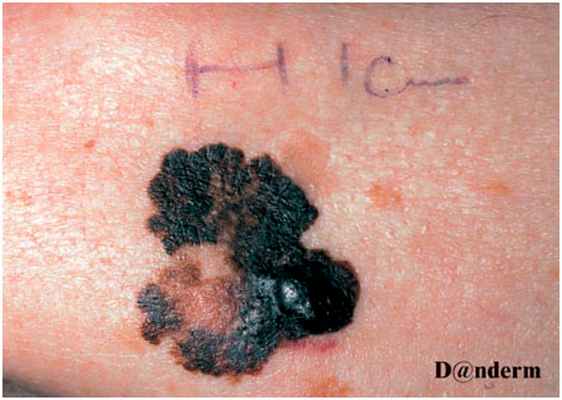 Узловая меланома