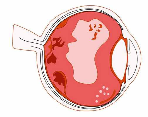 Деструкция стекловидного тела 