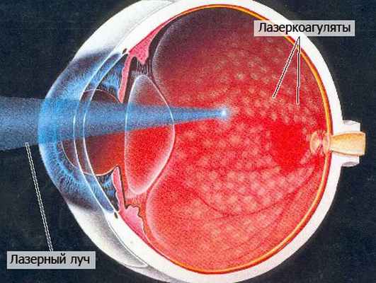 Лазерное лечение