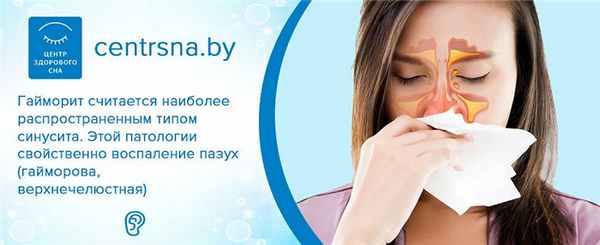 Гайморит это. Воспаление гайморовой пазухи