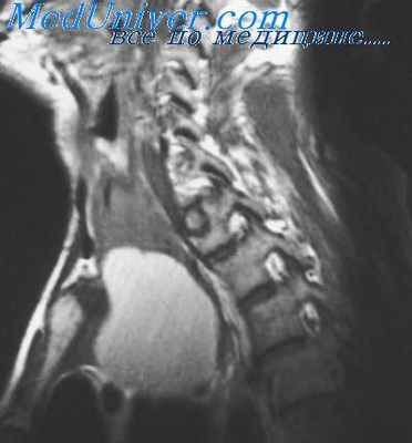 диафрагмальный нерв