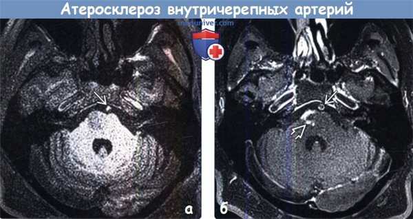 Атеросклероз внутричерепных артерий на МРТ