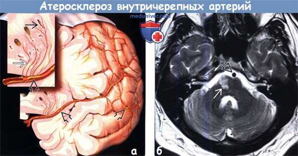 Атеросклероз внутричерепных артерий на МРТ