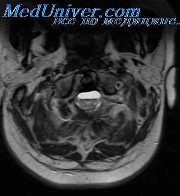 отогенный арахноидит