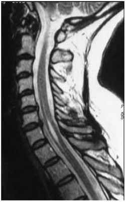 сирингомиелия, грыжа диска