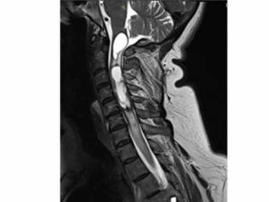 опухоль спинного мозга, сирингомиелия