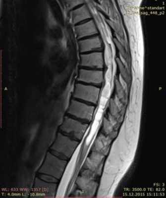 арахноидит, сирингомиелия