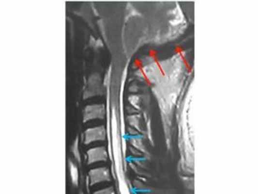 аномалия Киари, сирингомиелия, платибазия