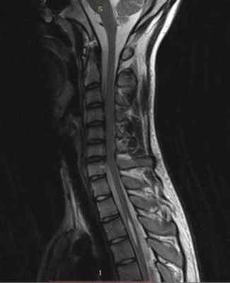 сирингомиелия, стеноз позвоночного канала