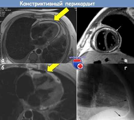 МРТ и рентгенография при констриктивном перикардите