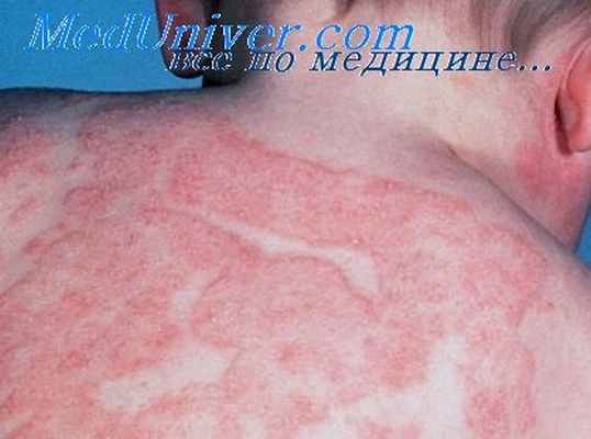 вегетирующая пузырчатка