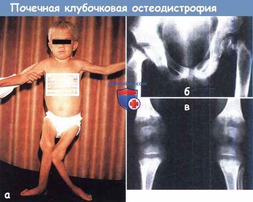 Почечная остеодистрофия у ребенка