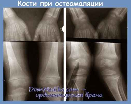 Кости при остеомаляции