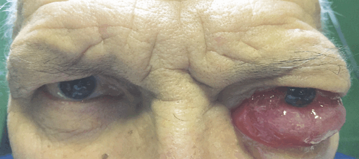 Видео прибор и методика экзофтальмометрии