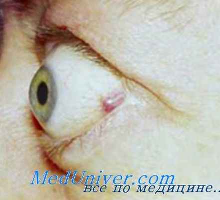 дифференциация экзофтальма