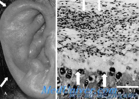 ушной менингит