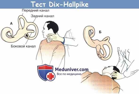 Тест Дикса-Халлпика