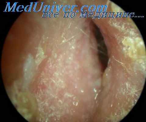 хронический эпитимпанит